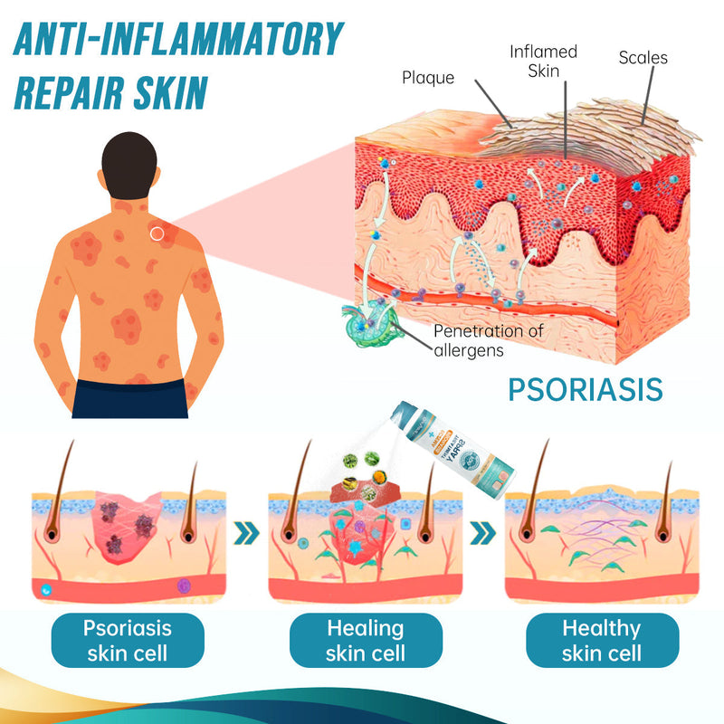 Psoriasis and Eczema Natural Herbal Treatment Spray(🍀Suitable for all skin types)