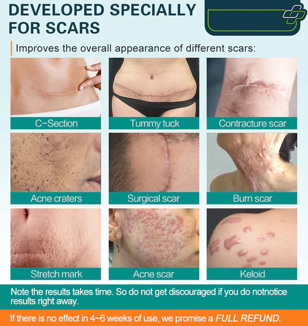 ❤️Advanced Scar Spray For All Types of Scars - For example Acne Scars, Surgical Scars and Stretch Marks ⚡️⚡️⚡️