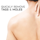 CalesCare ™  WipeOff Tags & Mole Remover